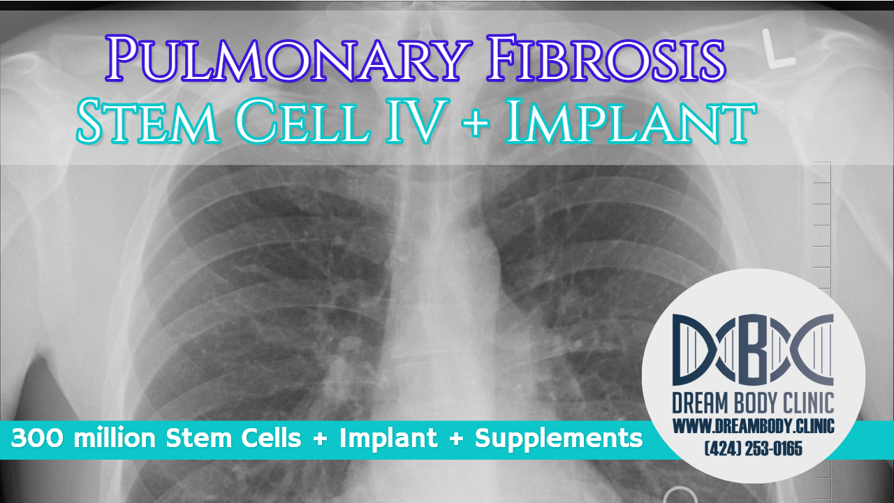 Pulmonary Fibrosis Stem Cell Treatment Dreambody Clinic