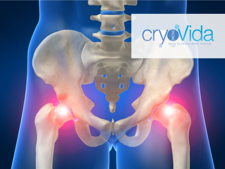 Stem Cell Hip Repair Treatment at Dream Body Clinic