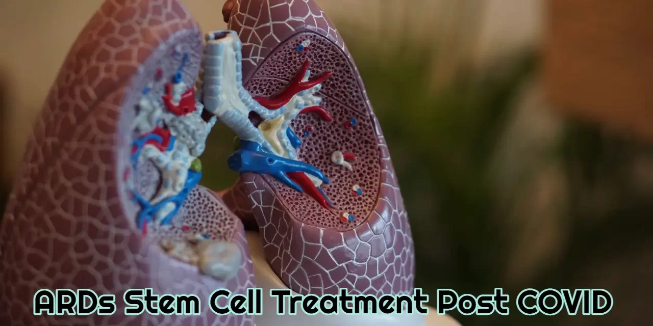 ARDs Stem Cell Treatment Post Covid