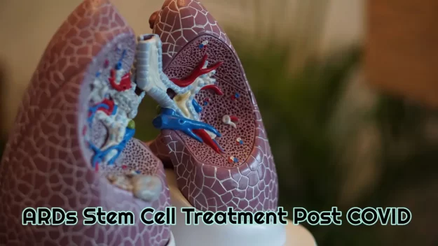 ARDs Stem Cell Treatment Post Covid
