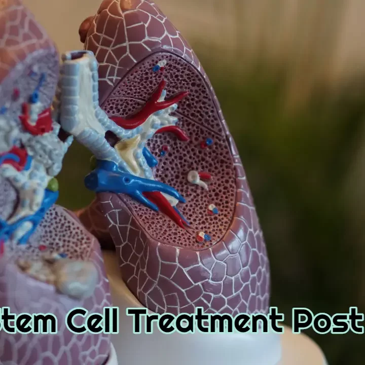 ARDs Stem Cell Treatment Post Covid