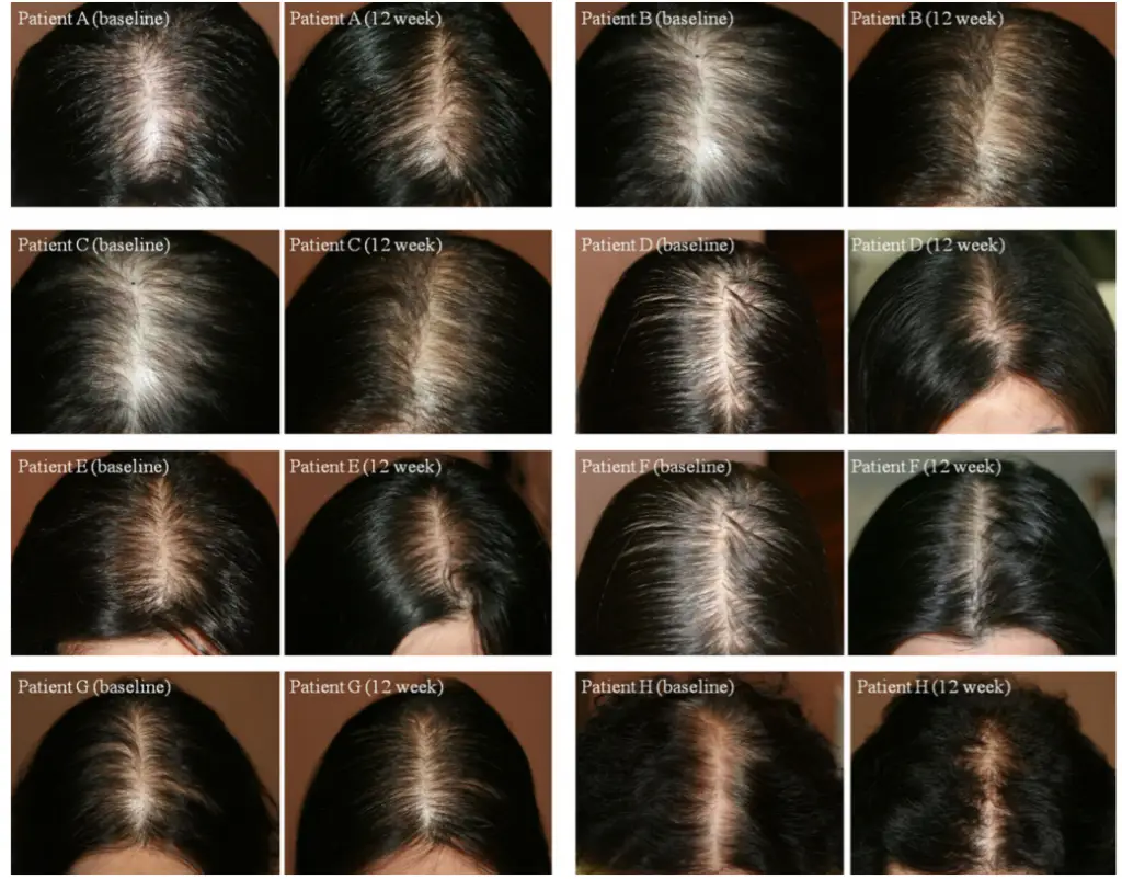 female stem cell hair restoration before and after study results dream body clinic