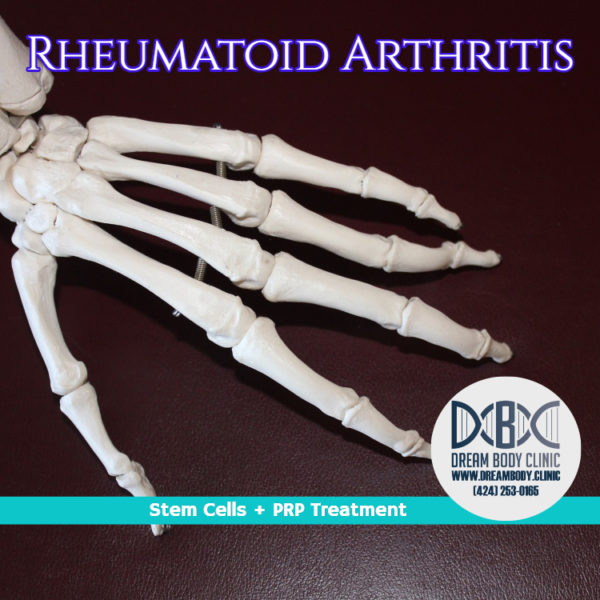 reumatoid arthritis stem cell treatment shop