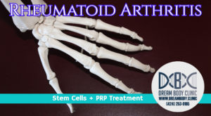 rheumatoid arthritis stem cell treatment
