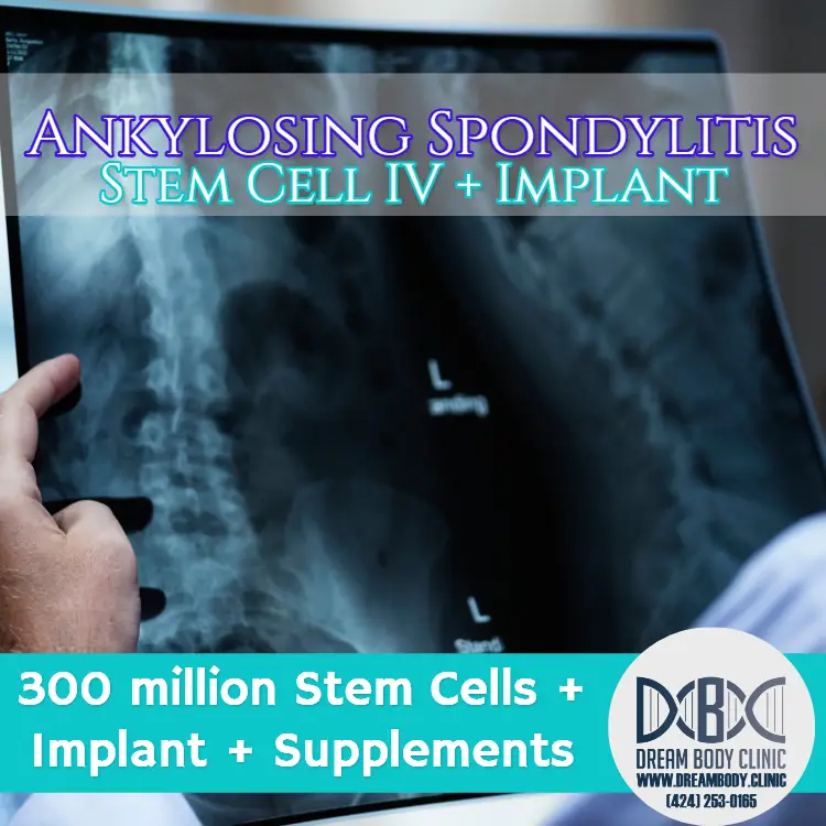 Ankylosing Spondylitis stem cell treatment