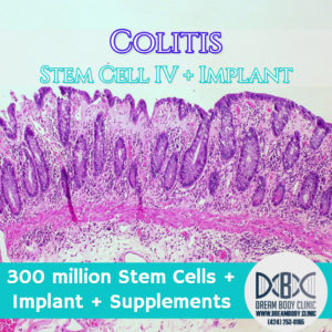 Colitis Stem Cell Treatment Dreambody Clinic