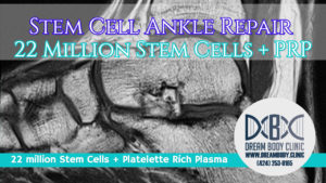 stem cell ankle repair dreambody clinic