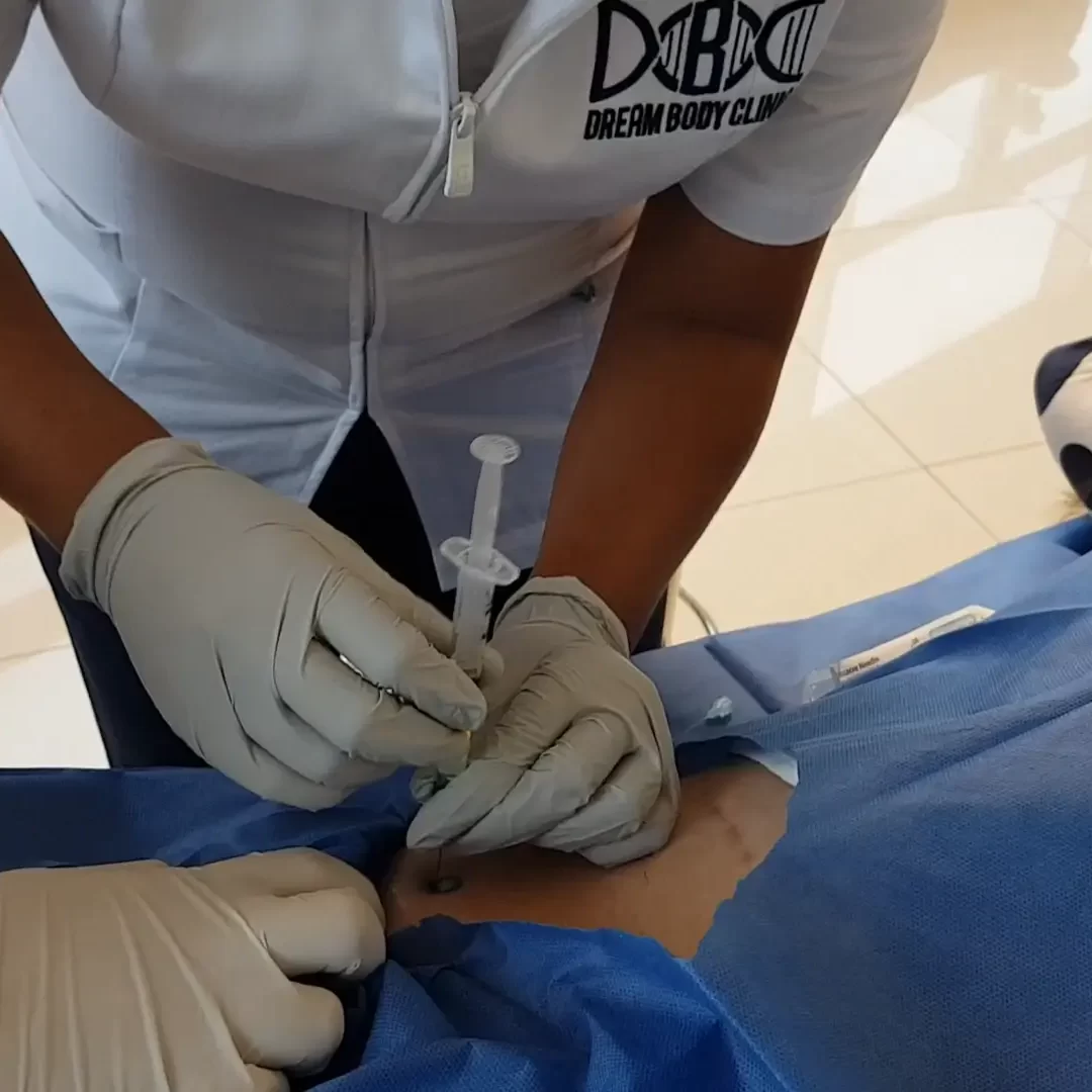 Stem Cell Hip Treatment at vallarta stem cells