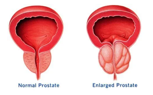 enlarged prostate stem cell treatment at dream body clinic puerto vallarta mexico