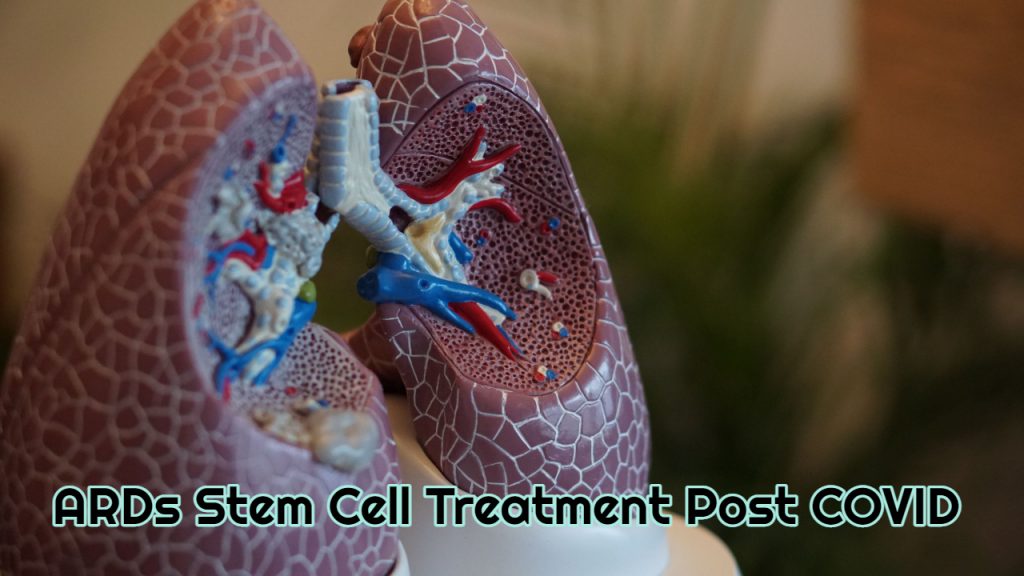 ARDs Stem Cell Treatment Post Covid