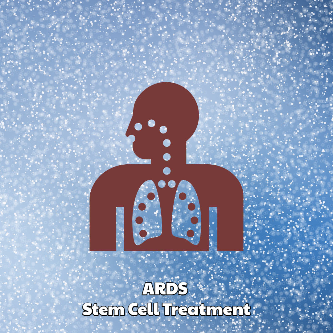 Ards Stem Cell Treatment Dreambody Clinic 0094