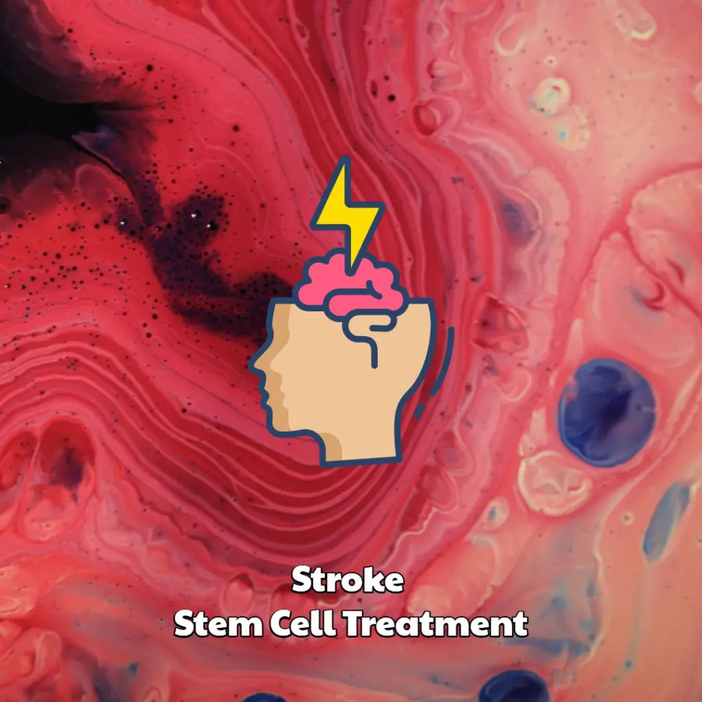 Stroke Stem Cell Treatment