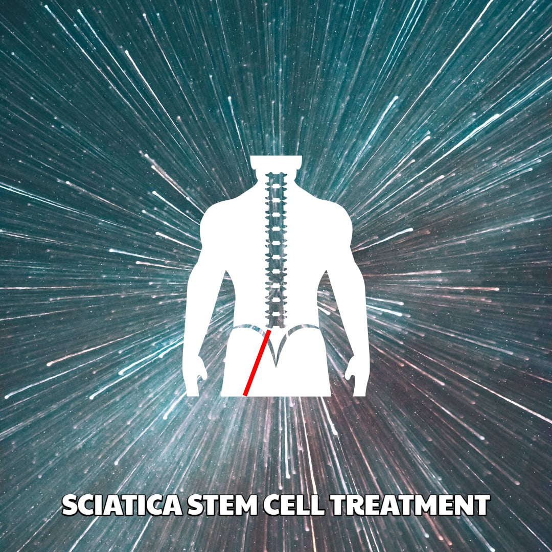 SCIATICA STEM CELL