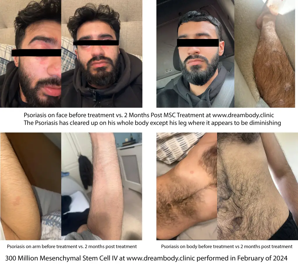 Zohaib Psoriasis Results 2 months post treatment