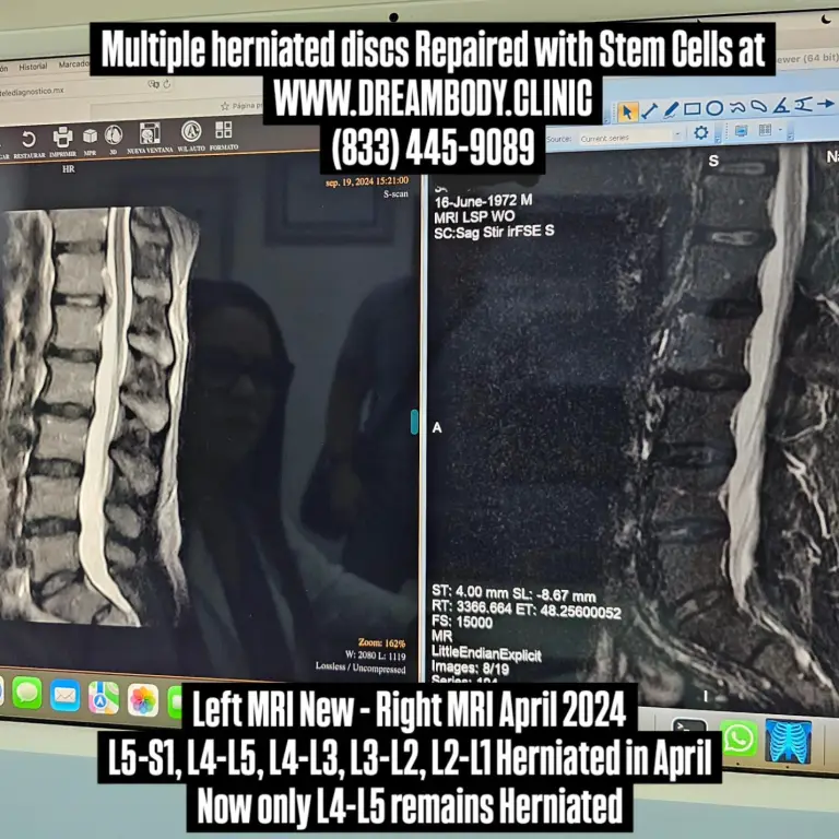 Dan Page Back MRI Before and After Stem CEll Therapy at Dream Body Clinic