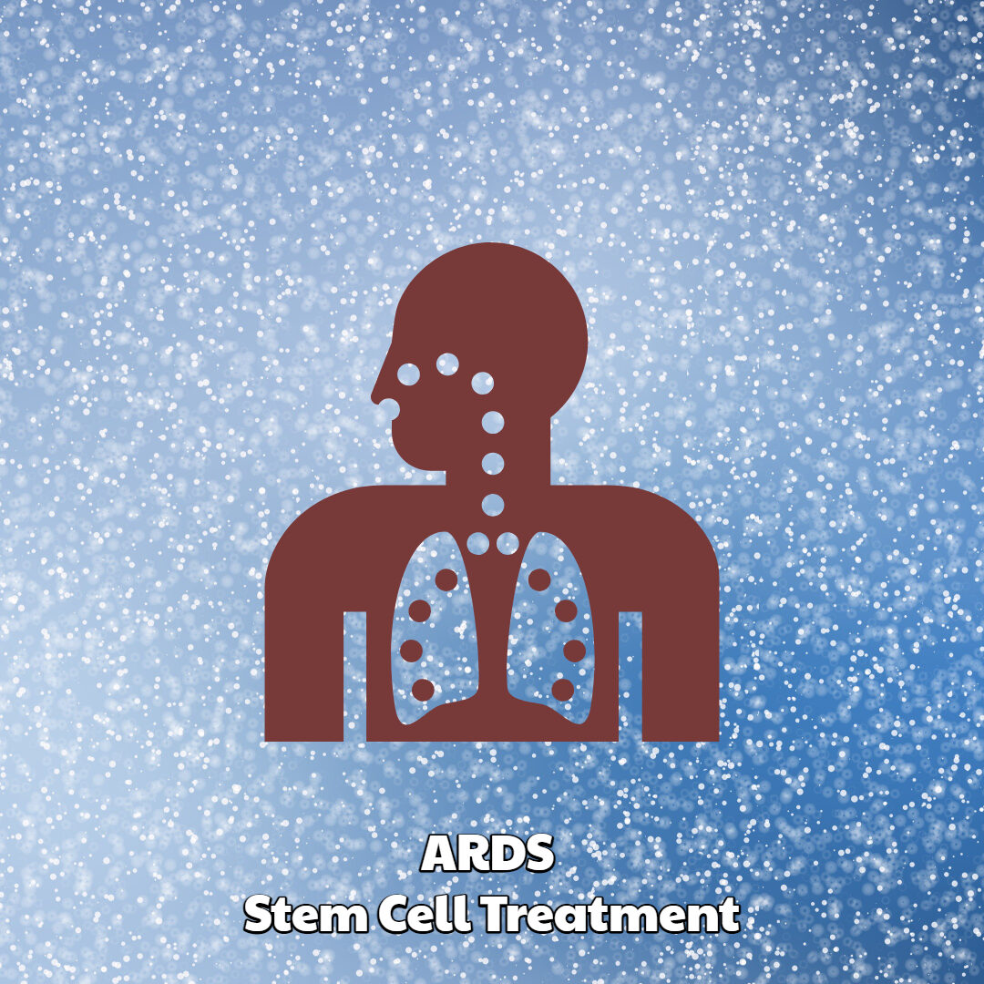 ARDS STEM CELL TREATMENT DREAM BODY CLINIC
