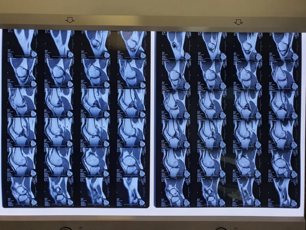 Josh Knee MRI Comparrisons from May 2017 to Feb 2018 Dream Body Clinic Stem Cells 1