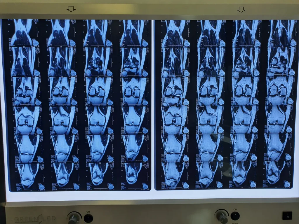 Josh Knee MRI Comparrisons from May 2017 to Feb 2018 Dream Body Clinic Stem Cells 2
