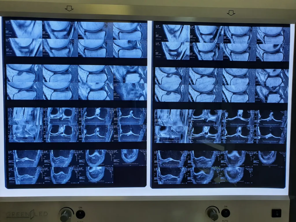 Josh Knee MRI Comparrisons from May 2017 to Feb 2018 Dream Body Clinic Stem Cells 3