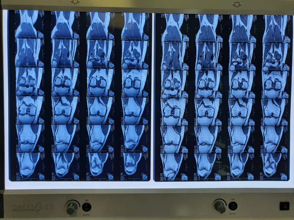 Josh Knee MRI Comparrisons from May 2017 to Feb 2018 Dream Body Clinic Stem Cells 4