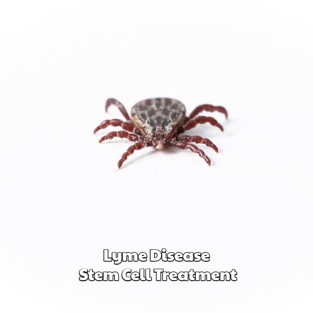 Lyme Disease Stem Cell Treatment Dream Body Clinic