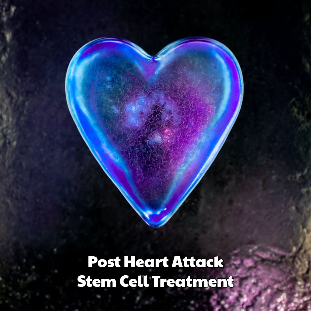 Post Heart Attack Stem Cell Treatment Dream Body Clinic
