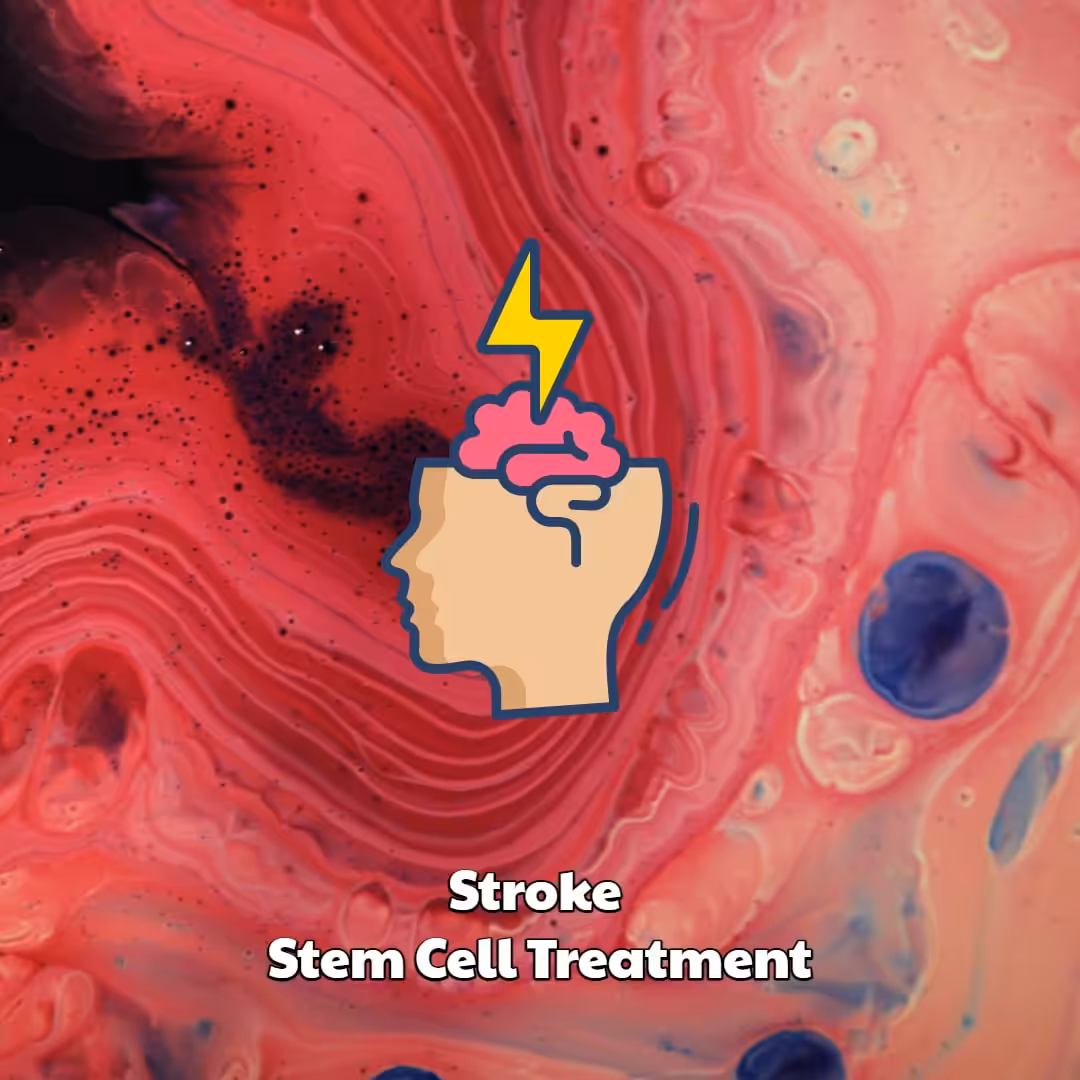 Stroke Stem Cell Treatment Dream Body Clinic