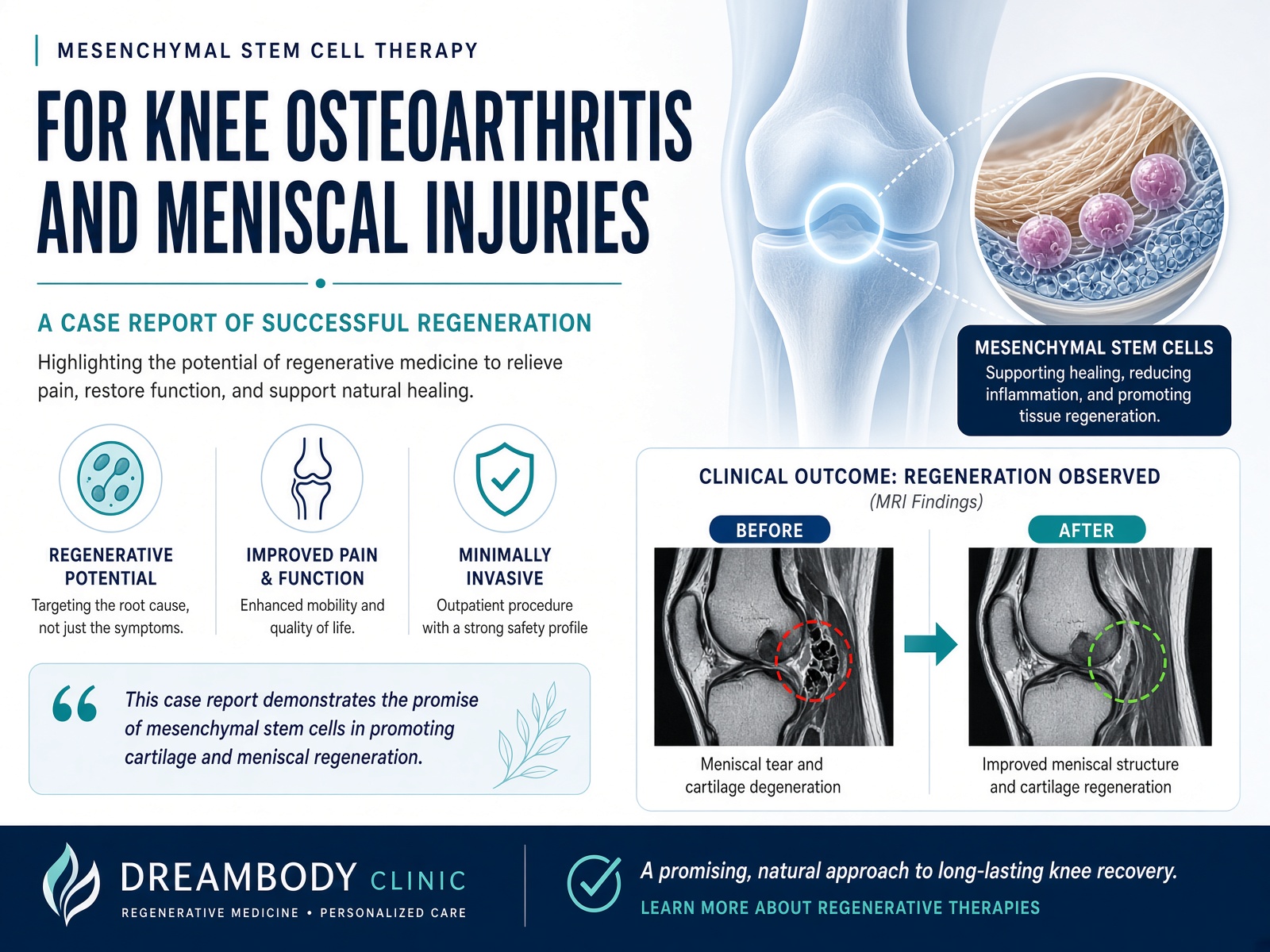 Case Study Knee Regeneration with Stem Cell Therapy