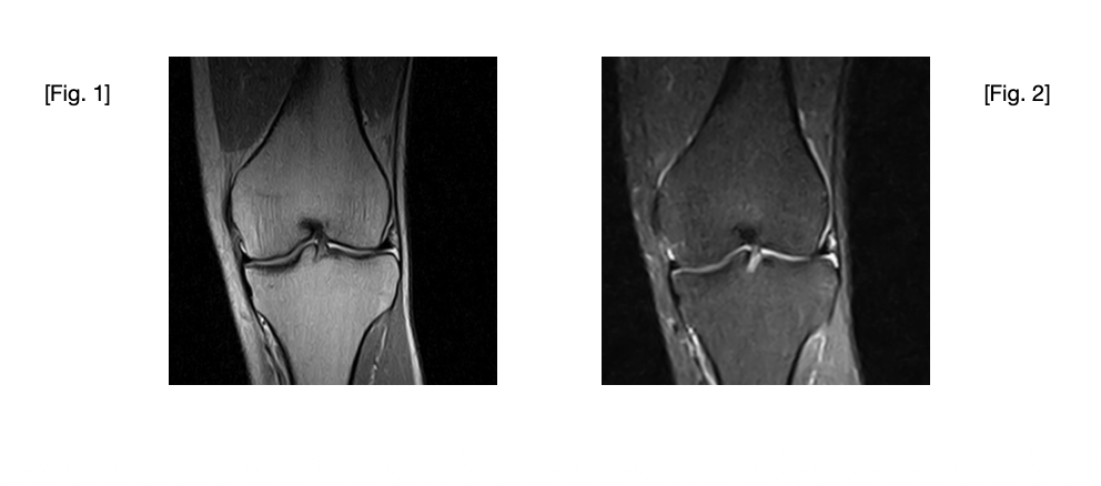Stem Cell Knee Repair Case Study Image 1