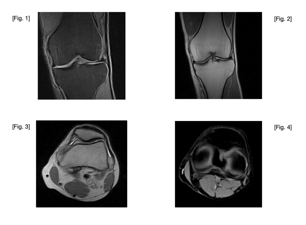 knee injury stem cell treatment case study