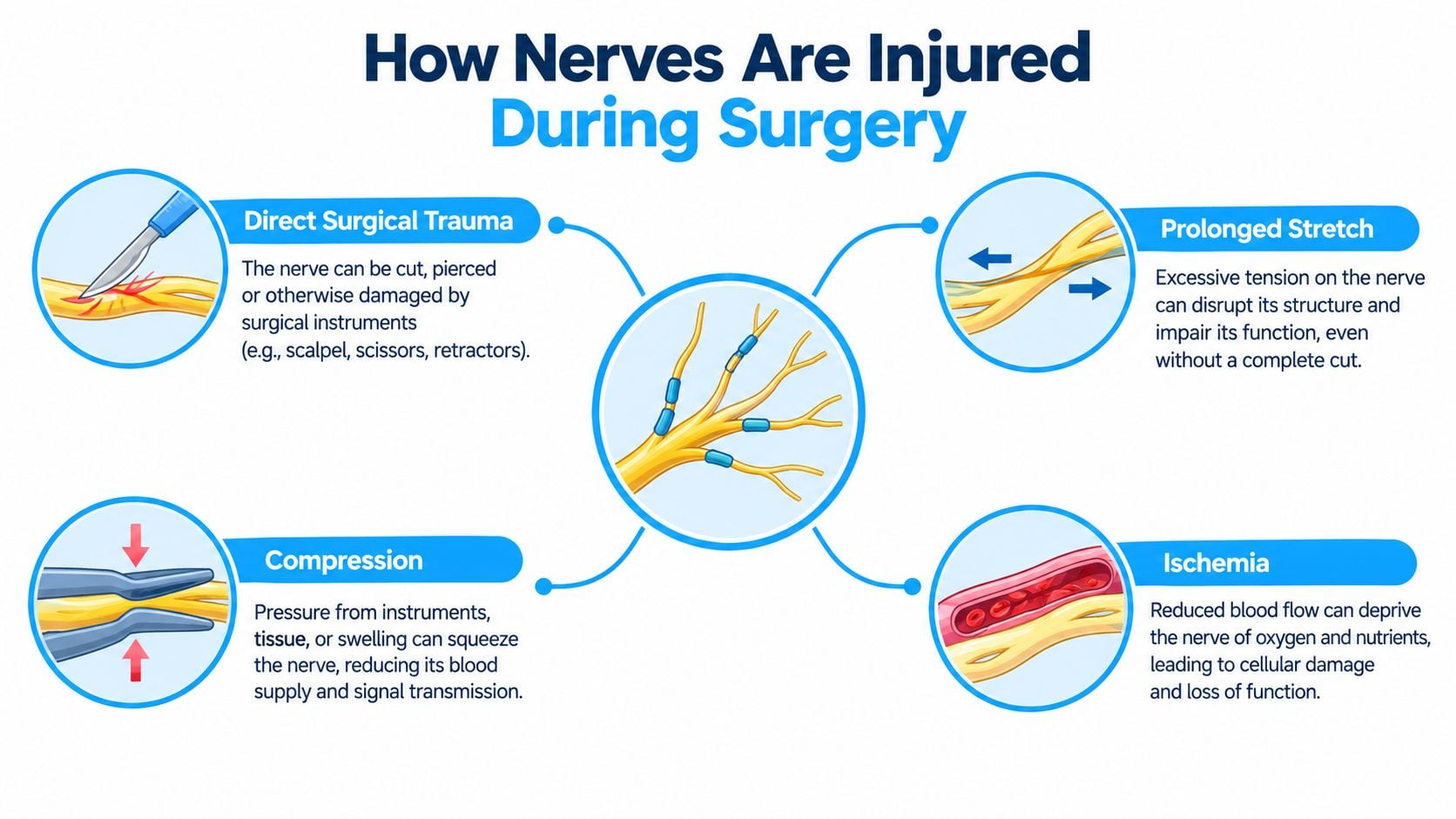 A diagram illustrating four primary mechanisms of how nerves can be injured during surgical procedures.